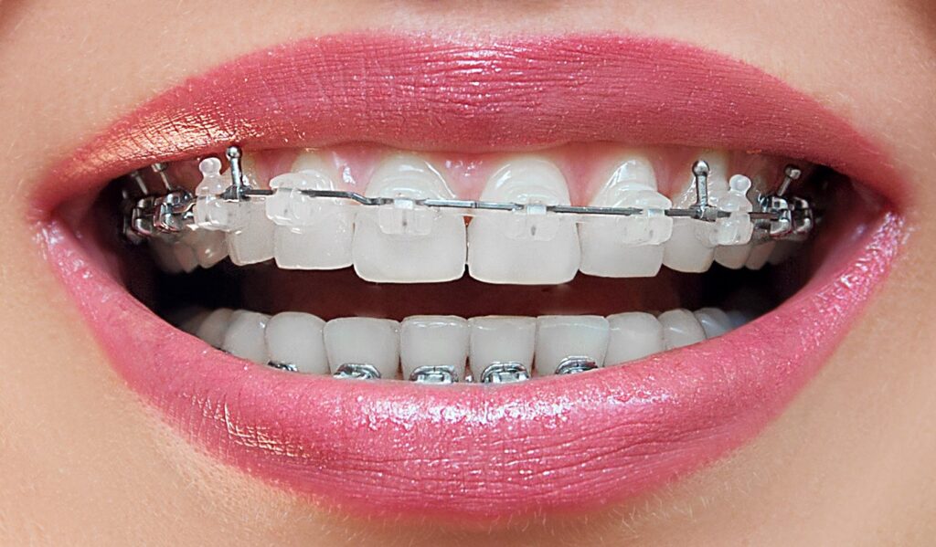 Aparat dentar ceramic