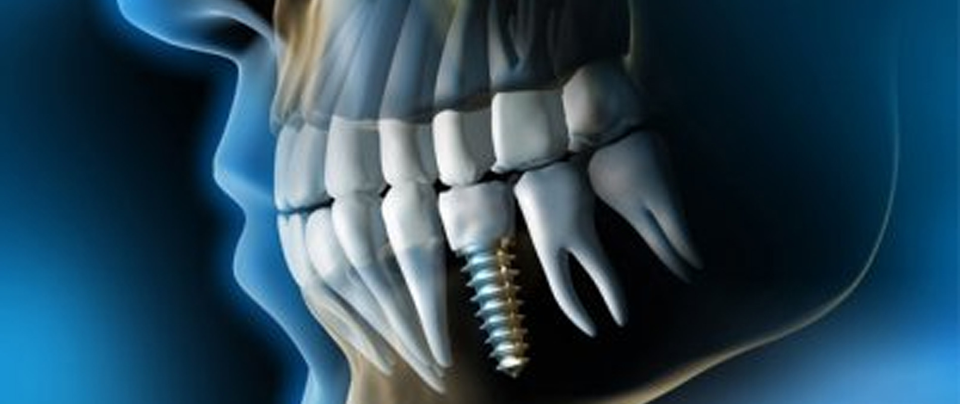 Implant Dentar