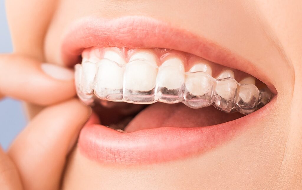 Invisalign